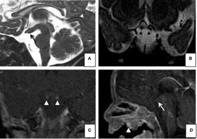 Duplication of the Pituitary Gland (DPG)-Plus Syndrome Associated With Midline Anomalies and Precocious Puberty: A Case Report and Review of the Literature